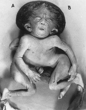 ilustrasi kembar siam cephalopagus (researchgate.net/K.P. Singh)