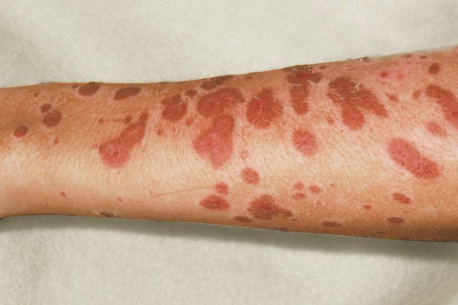 ilustrasi Stevens–Johnson syndrome (pharmaceutical-journal.com)