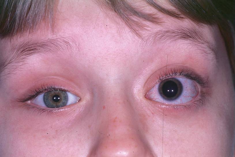 ilustrasi anak dengan optik glioma (link.springer.com/Clinical Ophthalmic Oncology/Jonathan J. Dutton)