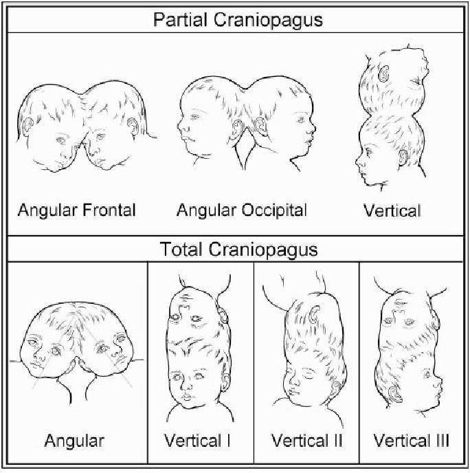 ilustrasi bayi kembar craniopagus (commons.wikimedia.org/शीतल सिन्हा)