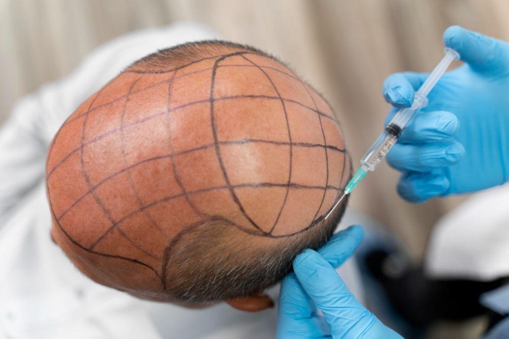 6 Fakta Transplantasi Rambut, Ampuh Tutupi Kebotakan