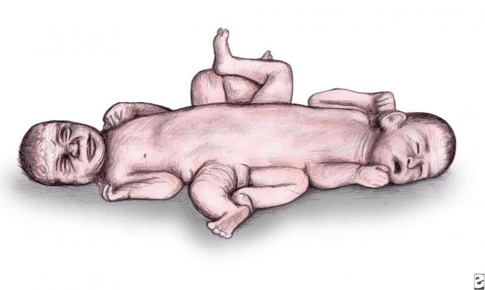 ilustrasi kembar siam ischiopagus (journal.medizzy.com)