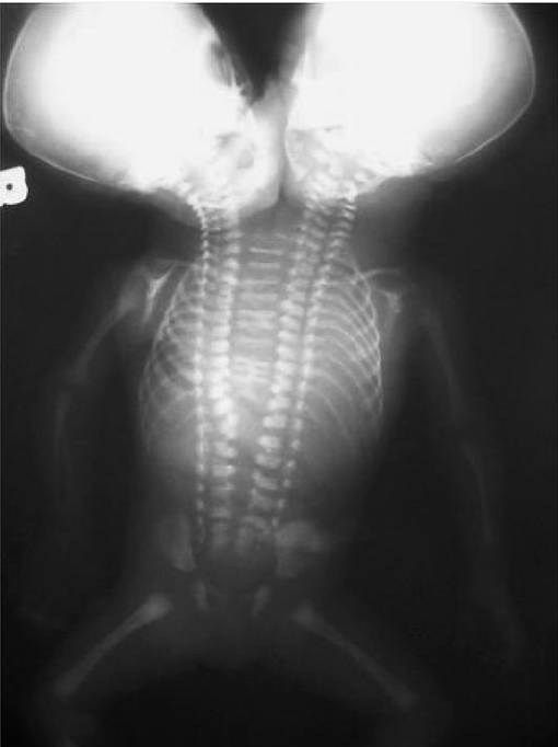 ilustrasi kembar siam dicephalic parapagus (researchgate.net/Muge Harma)
