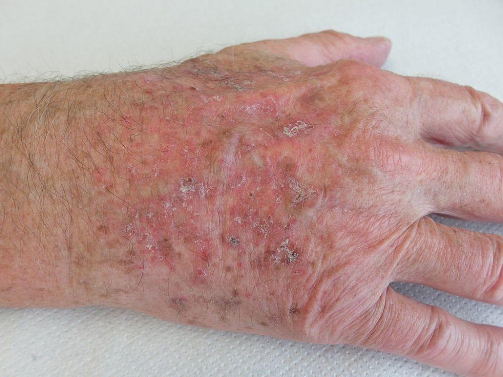 Actinic Keratosis: Penyebab, Gejala, Pengobatan, dan Pencegahan