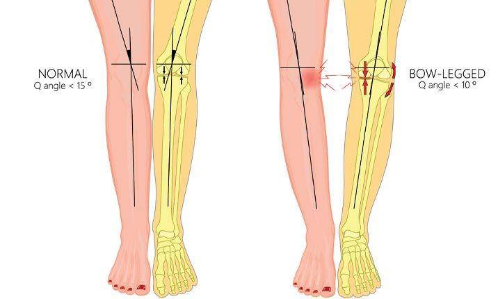 ilustrasi bentuk kaki O, genu varum, atau bow legs (mountelizabeth.com.sg)