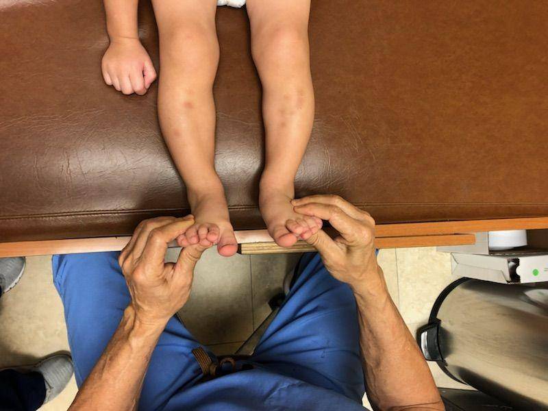 ilustrasi penanganan kaki O pada anak (southfloridasportsmedicine.com)