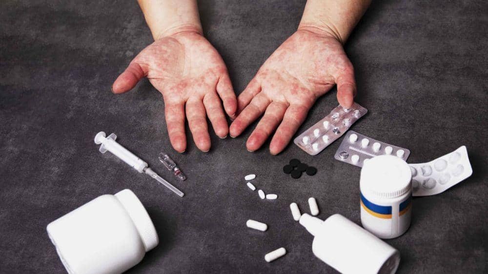 ilustrasi alergi obat (upmcphysicianresources.com)