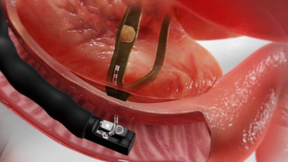 ilustrasi prosedur endoscopic retrograde cholangiopancreatography atau ERCP (hopkinsmedicine.org)