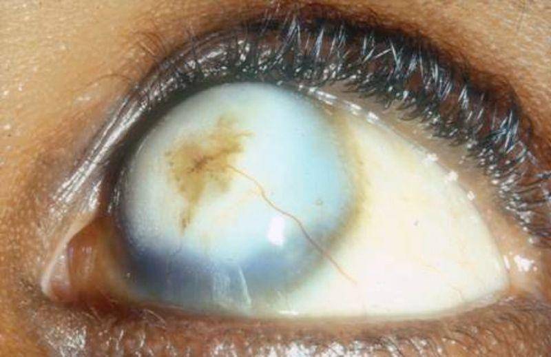 ilustrasi jaringan parut pada kornea akibat xerophthalmia (flickr.com/Community Eye Health/Clare Gilbert)