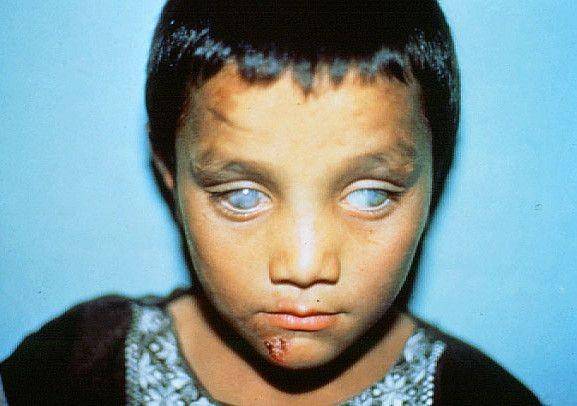 ilustrasi xerophthalmia pada anak (flickr.com/Community Eye Health/John DC Anderson)