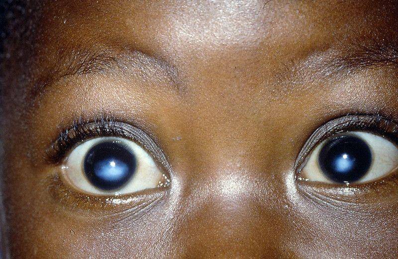 ilustrasi xerophthalmia (flickr.com/Community Eye Health/Margreet Hogeweg)