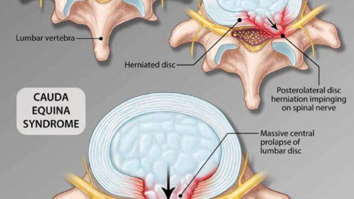 ilustrasi sindrom cauda equina (londonspine.com)