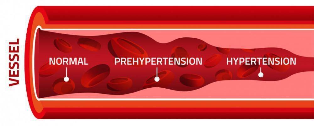 ilustrasi tekanan darah tinggi atau hipertensi (sprucemedicalgroup.com)