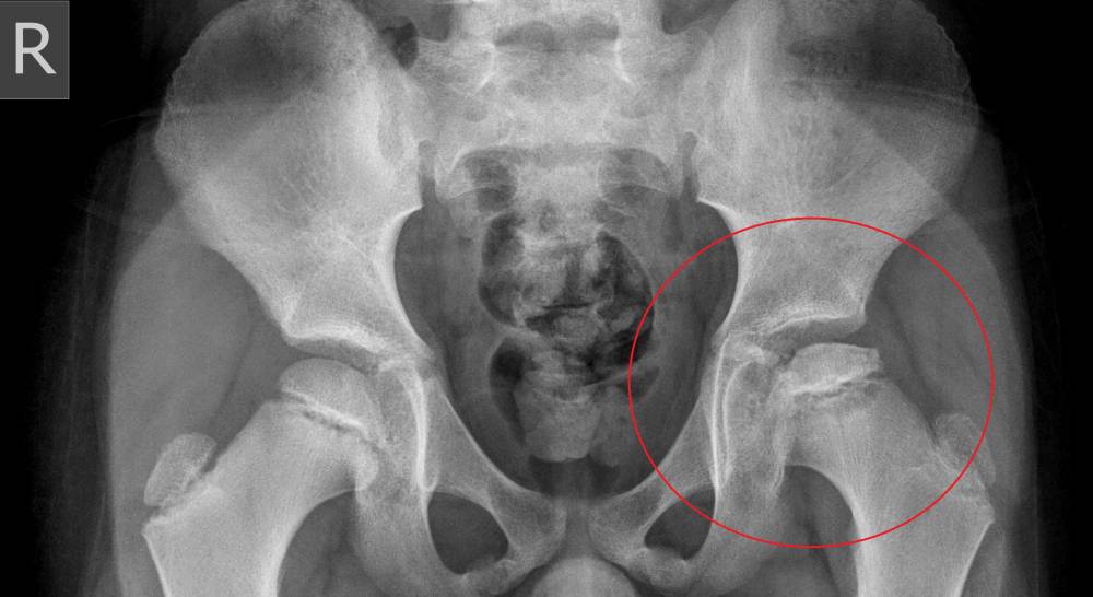 ilustrasi penyakit Legg-Calve-Perthes (orthopaedia.com)