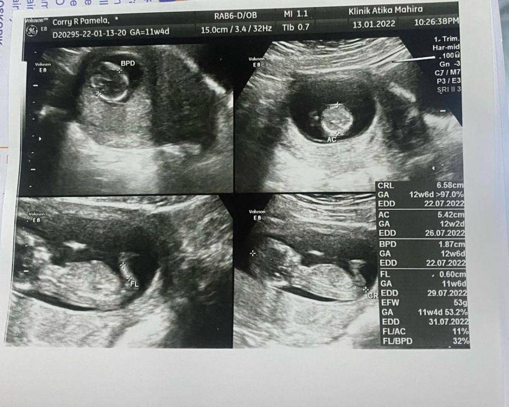 potret USG calon baby Corry Pamela (instagram.com/corrypamela)