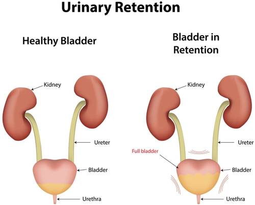 ilustrasi retensi urine (multiplesclerosisnewstoday.com)