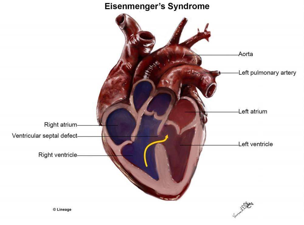 ilustrasi sindrom Eisenmenger (step2.medbullets.com)