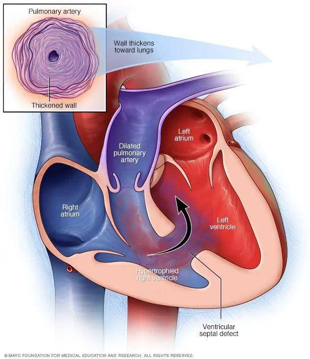 ilustrasi sindrom Eisenmenger (mayoclinic.org)