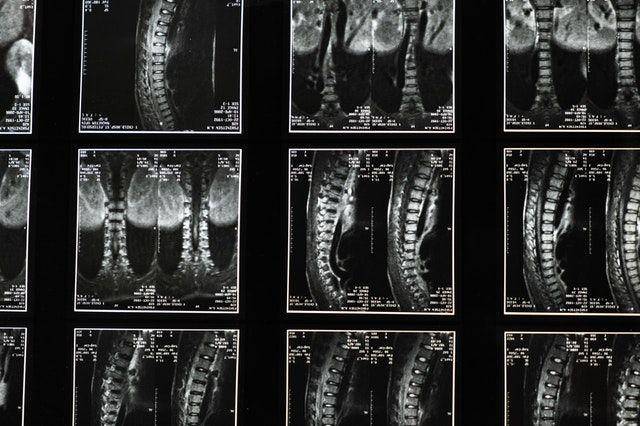 ilustrasi x-ray tulang belakang (pexels.com/cottonbro)