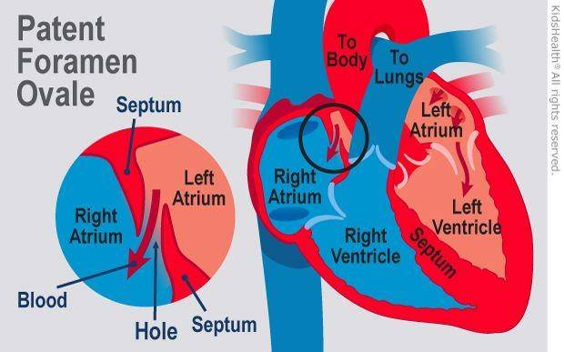 ilustrasi kelainan jantung bawaan patent foramen ovale (kidshealth.org)