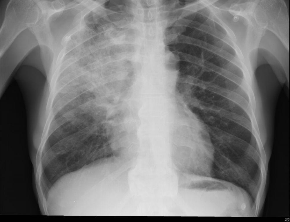 Apa Itu White Lung Pneumonia?