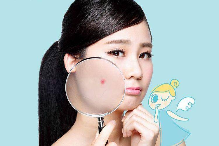 ilustrasi orang berjerawat (instagram.com/dermaangel_id)