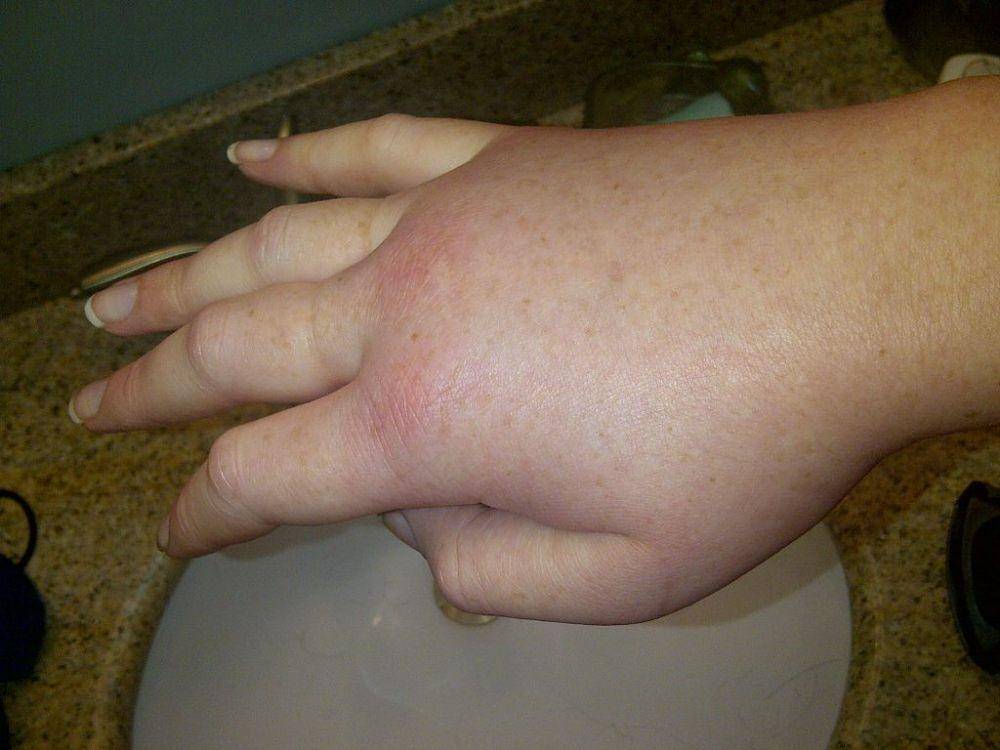 Tangan kanan bengkak pada pasien saat serangan angioedema herediter. (commons.wikimedia.org/LucyHAE)