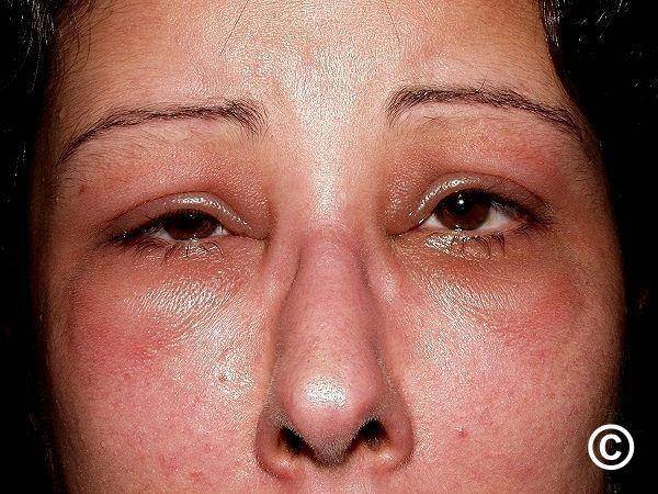 ilustrasi angioedema (pcds.org.uk)
