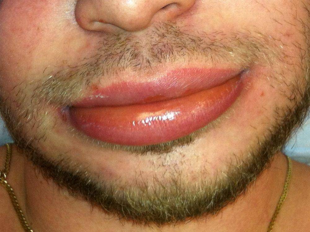 ilustrasi angioedema di bibir (commons.wikimedia.org/James Heilman, MD)