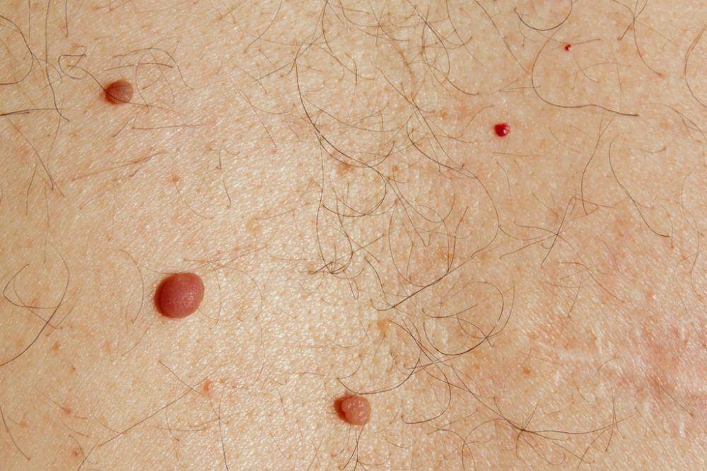 ilustrasi cherry angioma (imskinhealth.com)