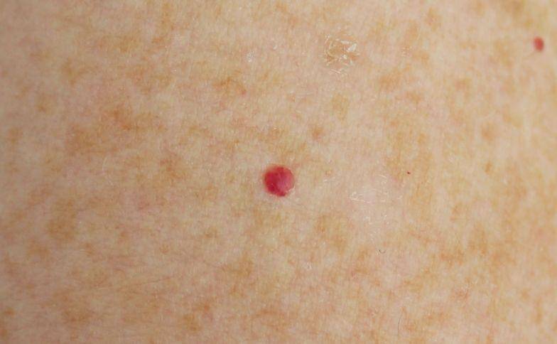 ilustrasi cherry angioma atau tahi lalat merah (skinsurgeryclinic.co.uk)