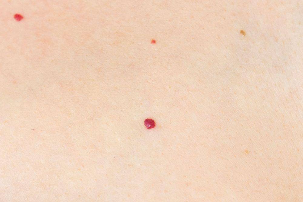 ilustrasi tahi lalat merah di kulit atau cherry angioma (availdermatology.com)