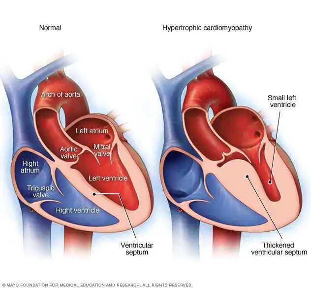 ilustrasi kardiomiopati hipertrofi (mayoclinic.org)