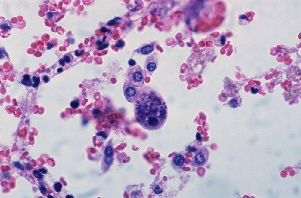 ilustrasi infeksi cytomegalovirus atau CMV (commons.wikimedia.org/Yale Rosen)
