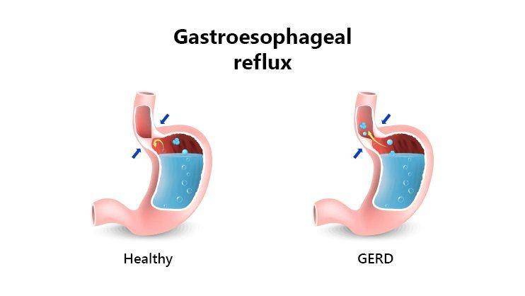 ilustrasi GERD (vaidjagjitsingh.com)