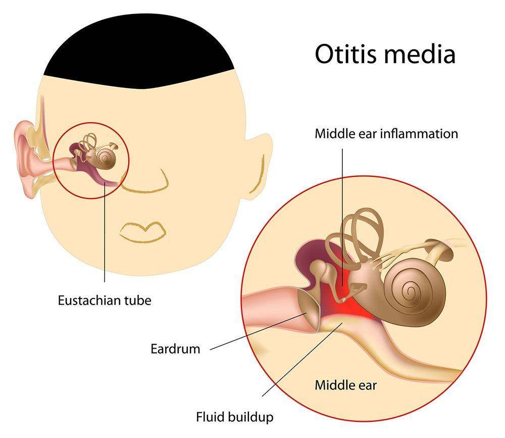 ilustrasi otitis media atau infeksi telinga tengah (healthdirect.gov.au)