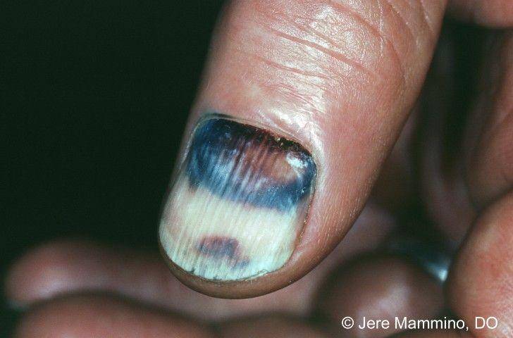 ilustrasi hematoma subungual (aocd.org)