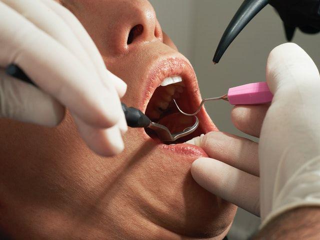 Hyperdontia: Penyebab, Gejala, Komplikasi, dan Penanganan