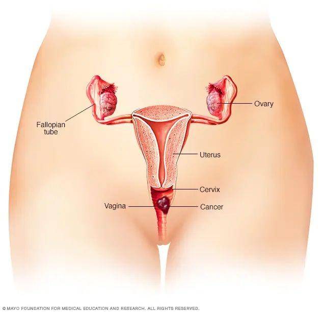 ilustrasi kanker vagina (mayoclinic.org)