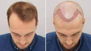 Transpalansi rambut. (fugamed.com).