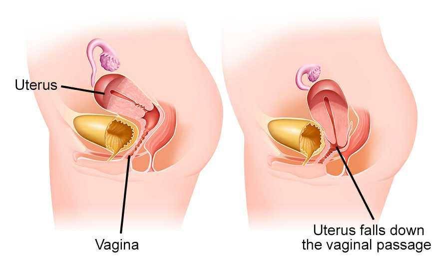 ilustrasi prolaps uteri (healthdirect.gov.au)