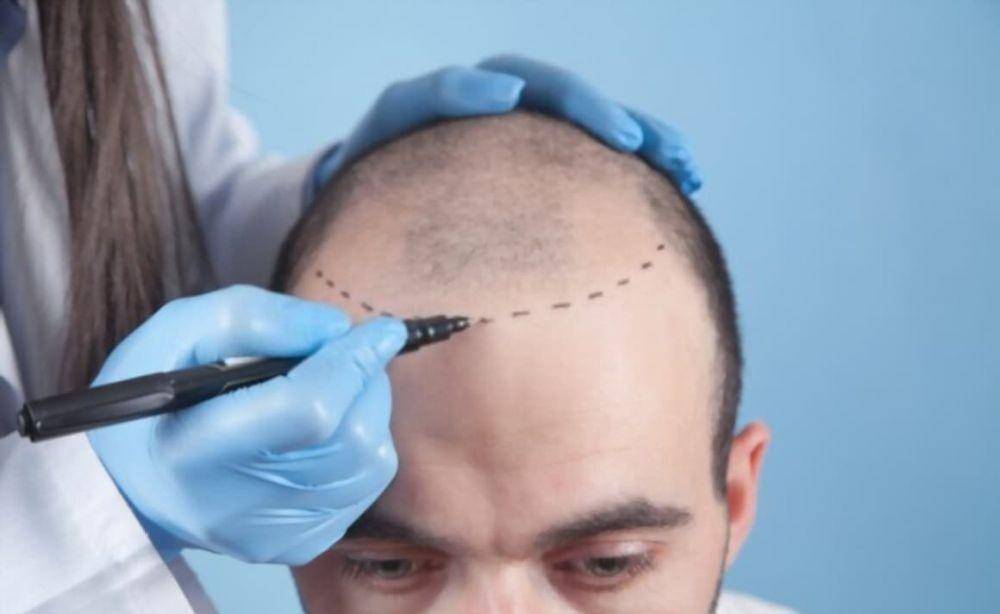 Transpalansi rambut. (ckhealthturkey.com)