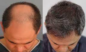 transpalansi rambut. (venushairrestoration).