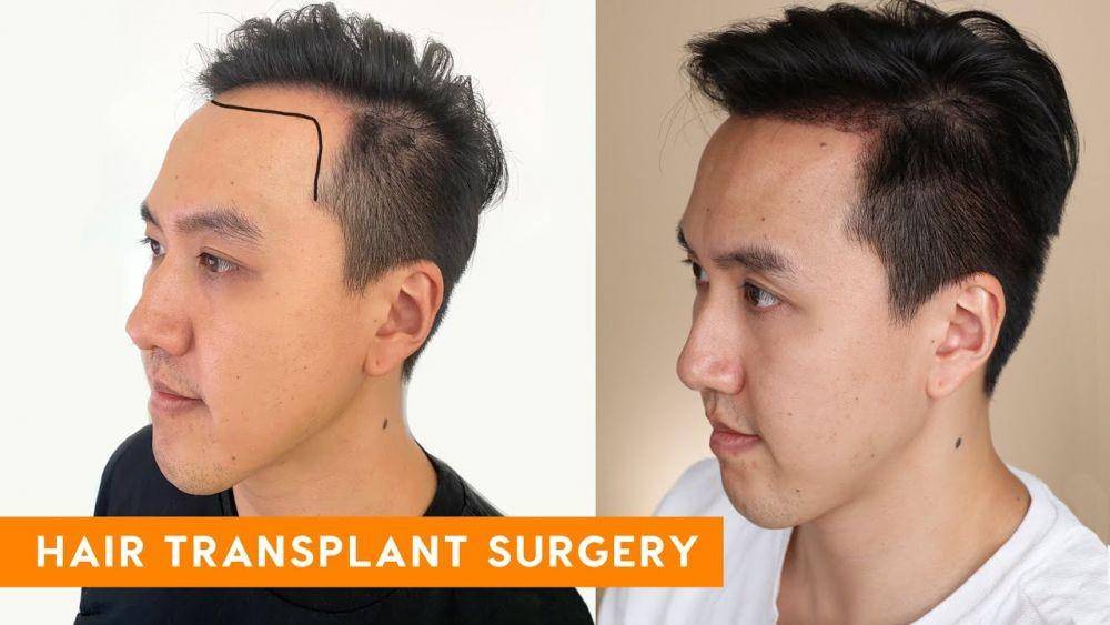 Transpalansi rambut. (youtube.com/tina yong).