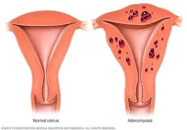 ilustrasi adenomiosis (mayoclinic.org)