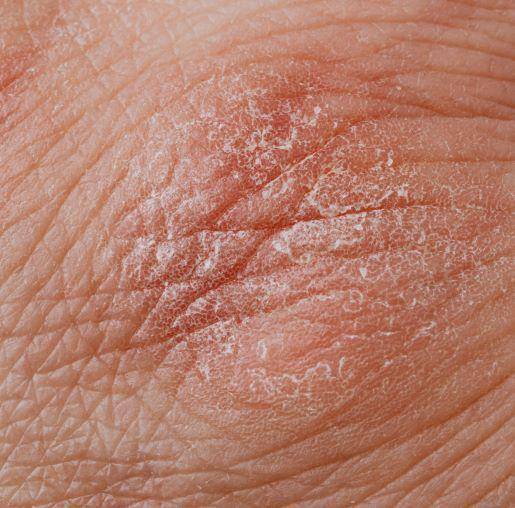 Ilustrasi skin barrier yang rusak. (Pexels.com/Karolina Grabowska)