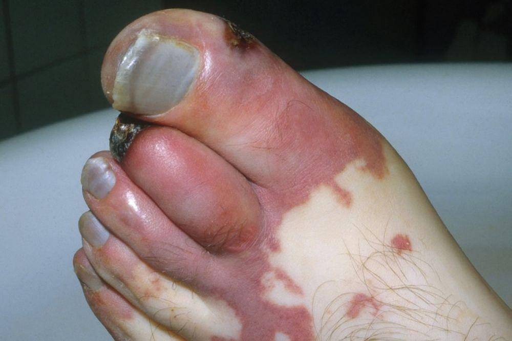 ilustrasi gangrene di kaki (healthjade.com)