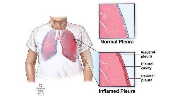 ilustrasi pleuritis (clevelandclinic.org)