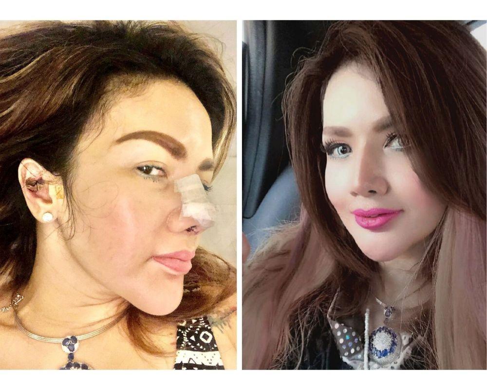 10 Potret Terbaru Barbie Kumalasari usai Operasi Hidung Ketiga Kalinya