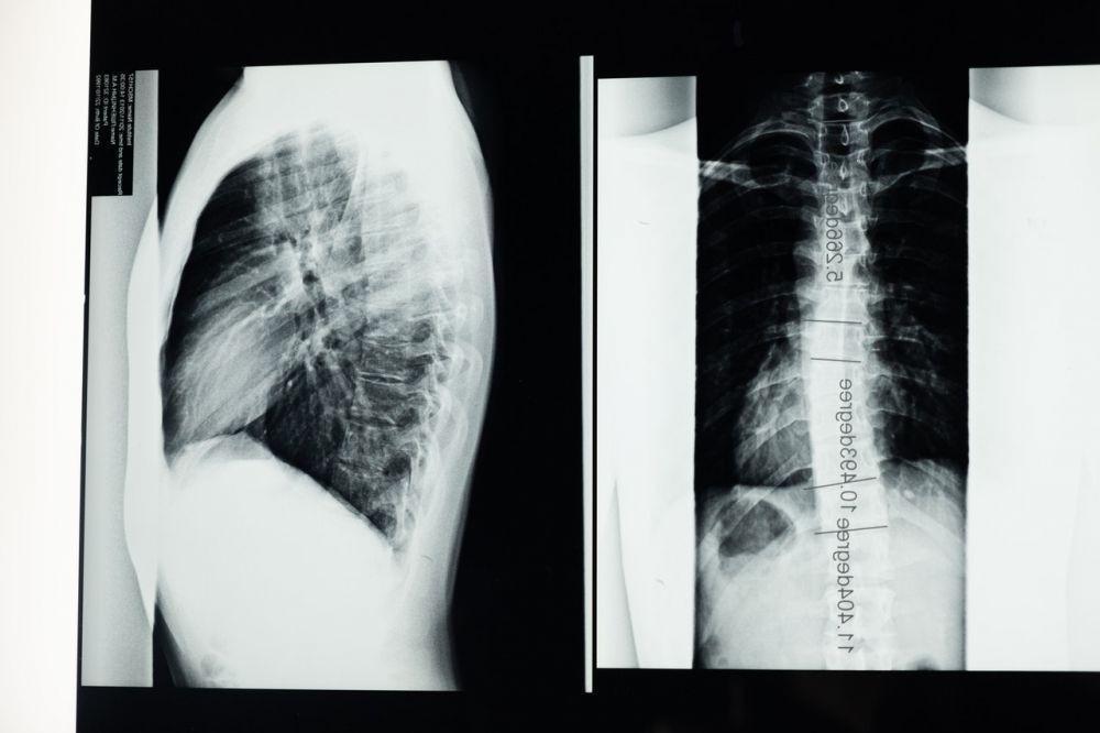 5 Latihan Ringan untuk Skoliosis, Punggung Jadi Lebih Nyaman